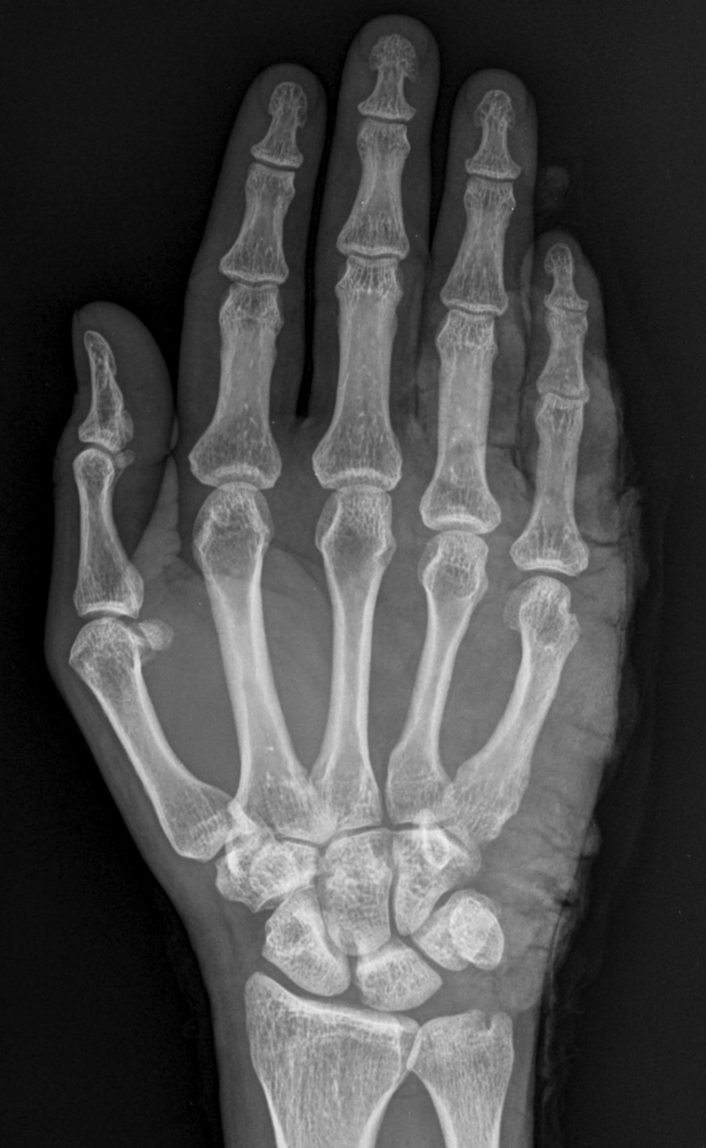 Radiographie de la main et du poignet, image d’illustration médicale